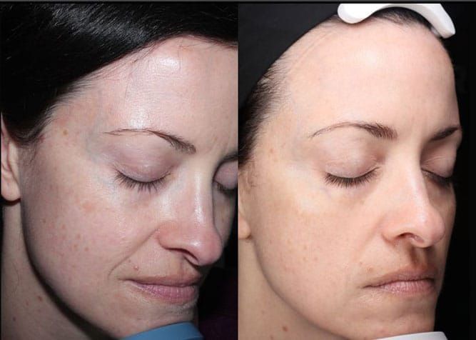 Comparison of woman's face before and after skin treatment, with reduced dark spots.