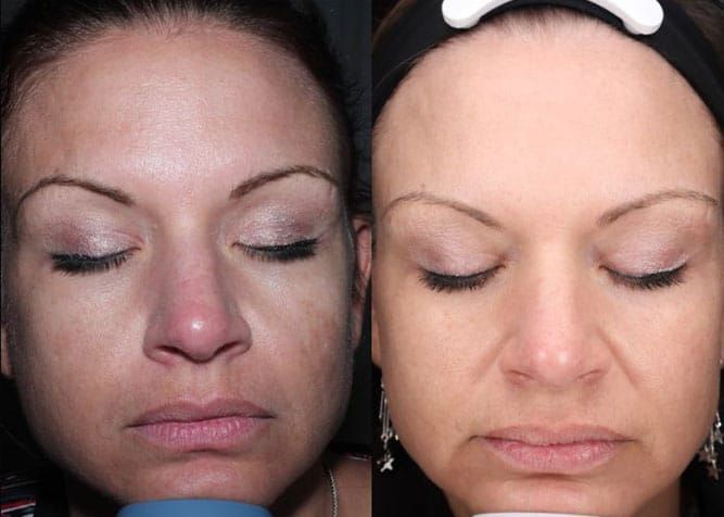 Side-by-side comparison of a person's face. Left side: Skin with discoloration. Right side: Skin appears improved.