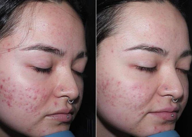 Two side-by-side photos of a person's face. Left shows acne, right shows improved skin after treatment.