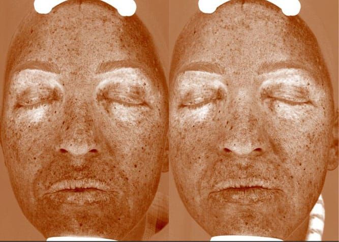 Two facial scans with numerous brown spots, appearing on the skin, showing signs of sun damage.
