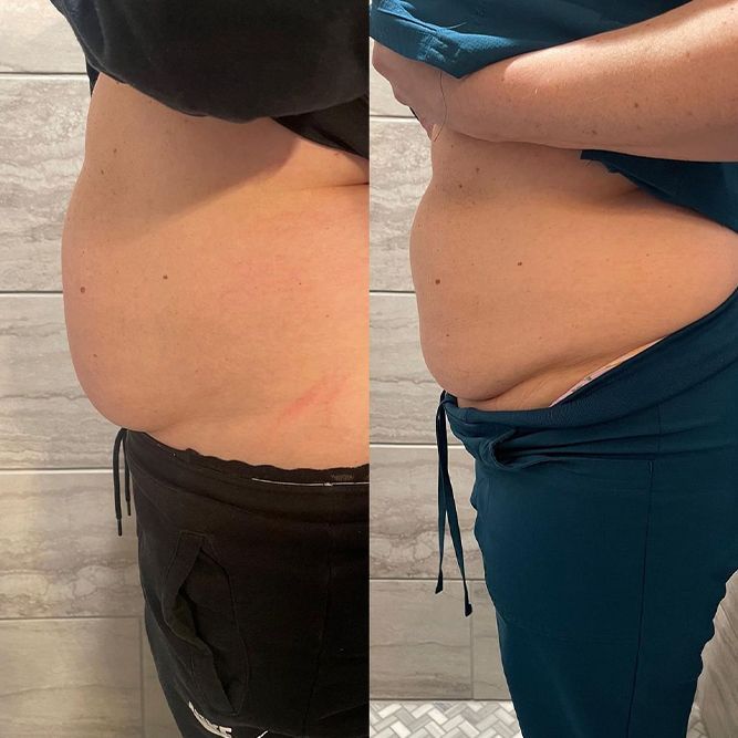 Side-by-side belly shots. Left: black pants. Right: teal top. Both show a person's abdomen, appearing slimmer on the right.