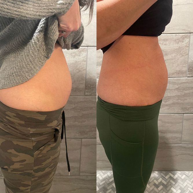 Side-by-side comparison of a person's abdomen, showing a visible difference in stomach size, before and after a change.