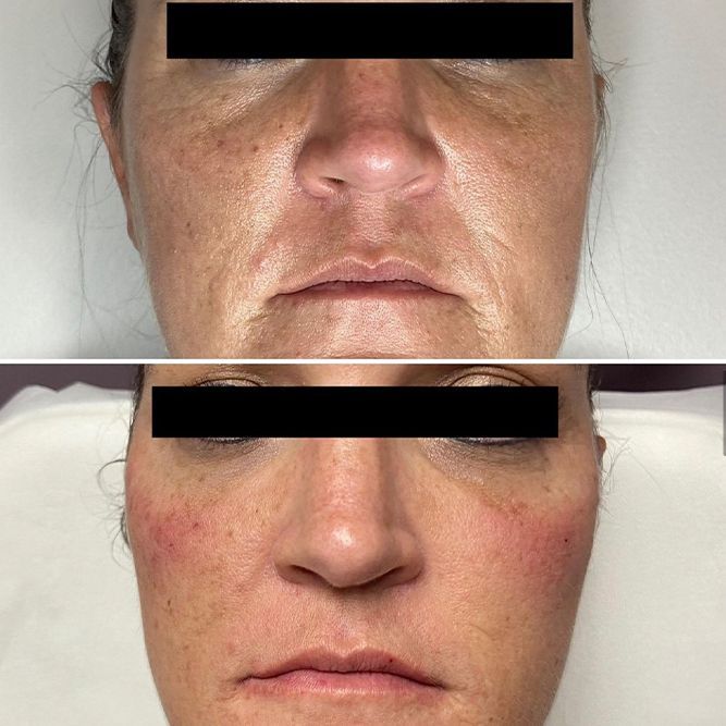 Comparison of a face before and after a treatment. Top: Fine lines and spots. Bottom: Smoother skin and redness.