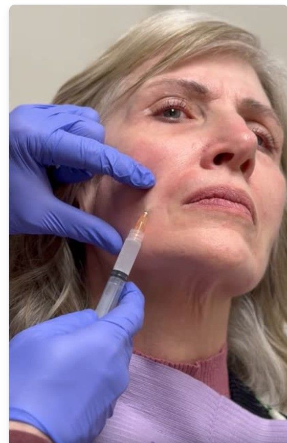 Facial injectable treatment Layton Utah
