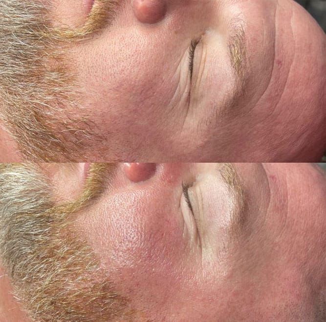 Before and after facial skin comparison. Smoother skin in the bottom image.
