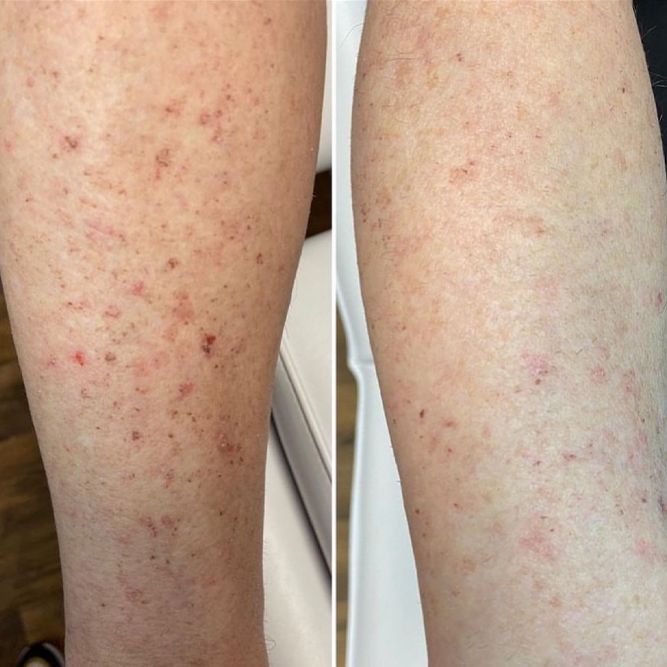 Legs with visible skin irritation, before and after treatment, showing reduction in redness and spots.