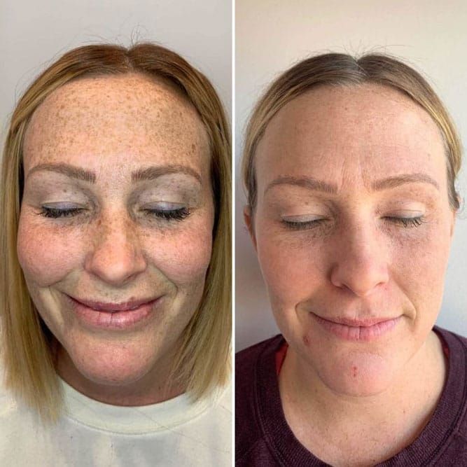 Before-and-after facial comparison: freckled skin on left, clear skin on right, woman smiling with eyes closed.