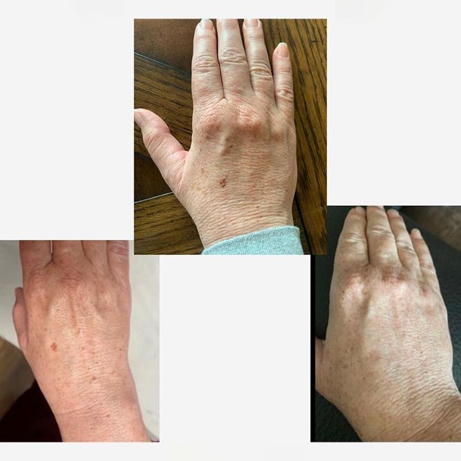 Three photos of a hand, showing light skin with brown spots, resting on a table.
