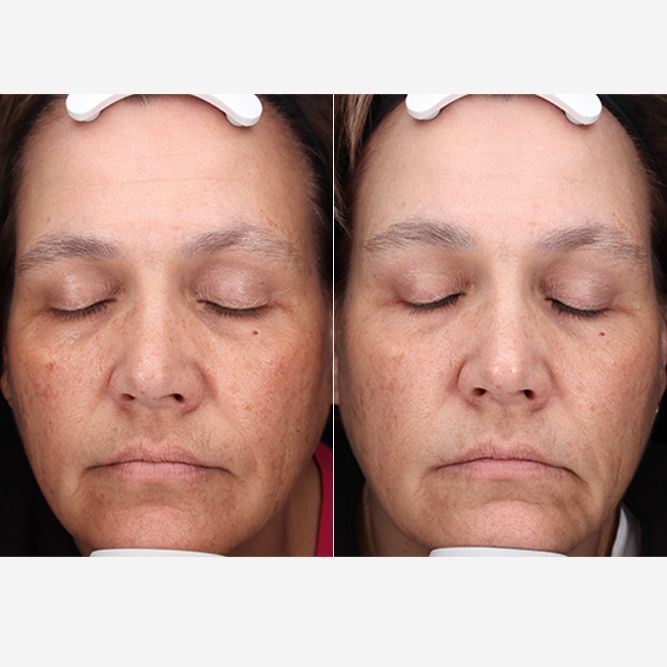 Side-by-side comparison of a person's face before and after a skin treatment, with reduced pigmentation.