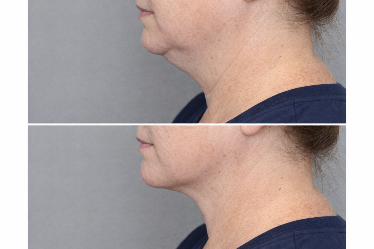Before and after Kybella treatment for submental fullness