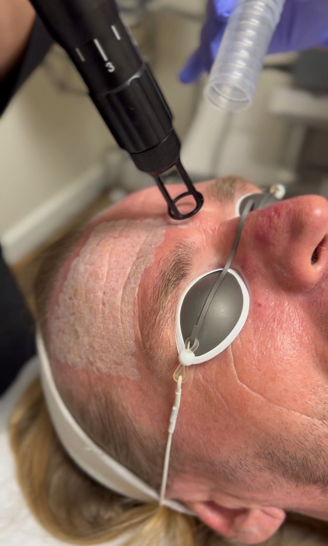 Laser Skin Resurfacing West Point, UT