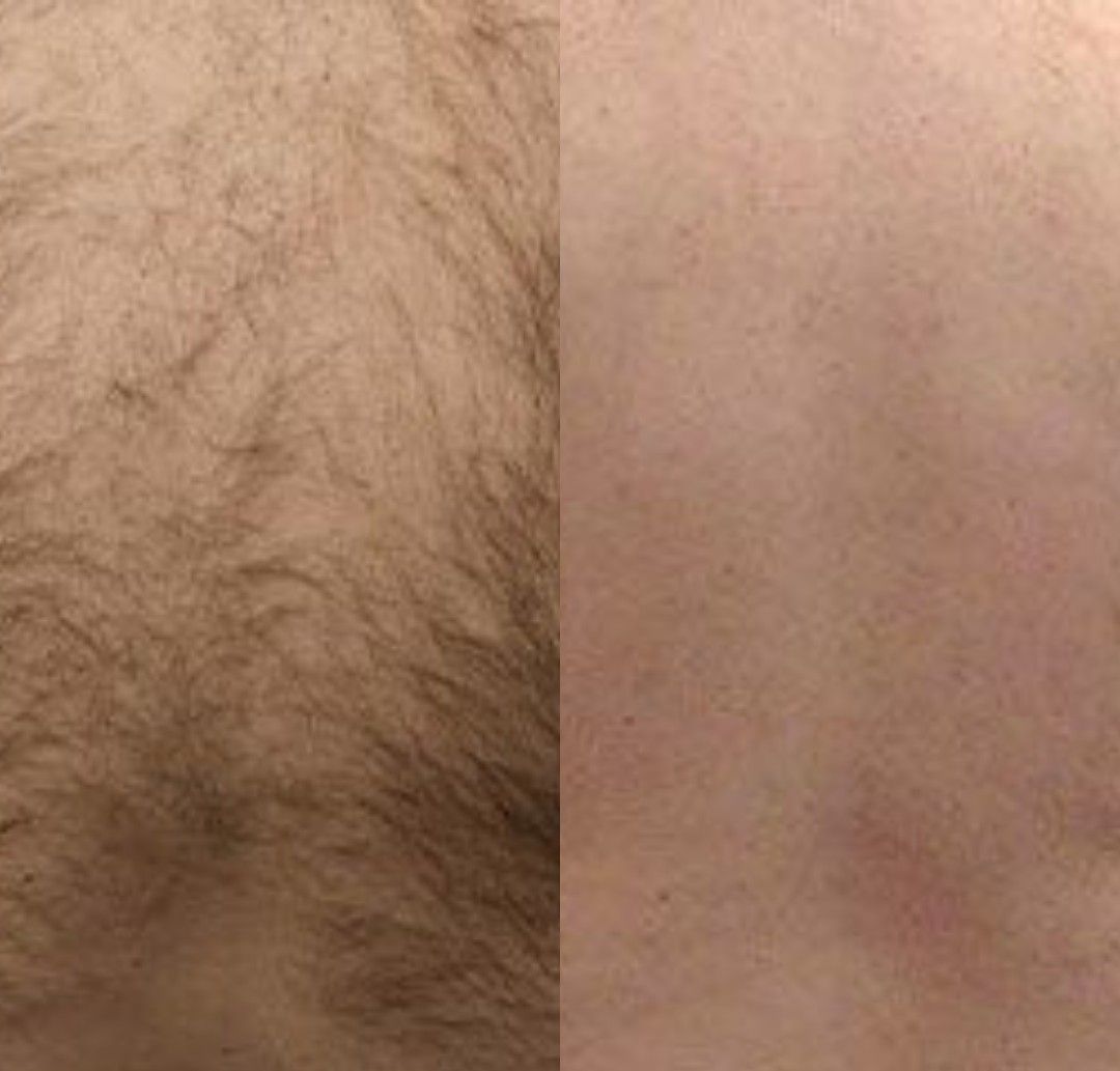 Laser hair removal man with back hair.