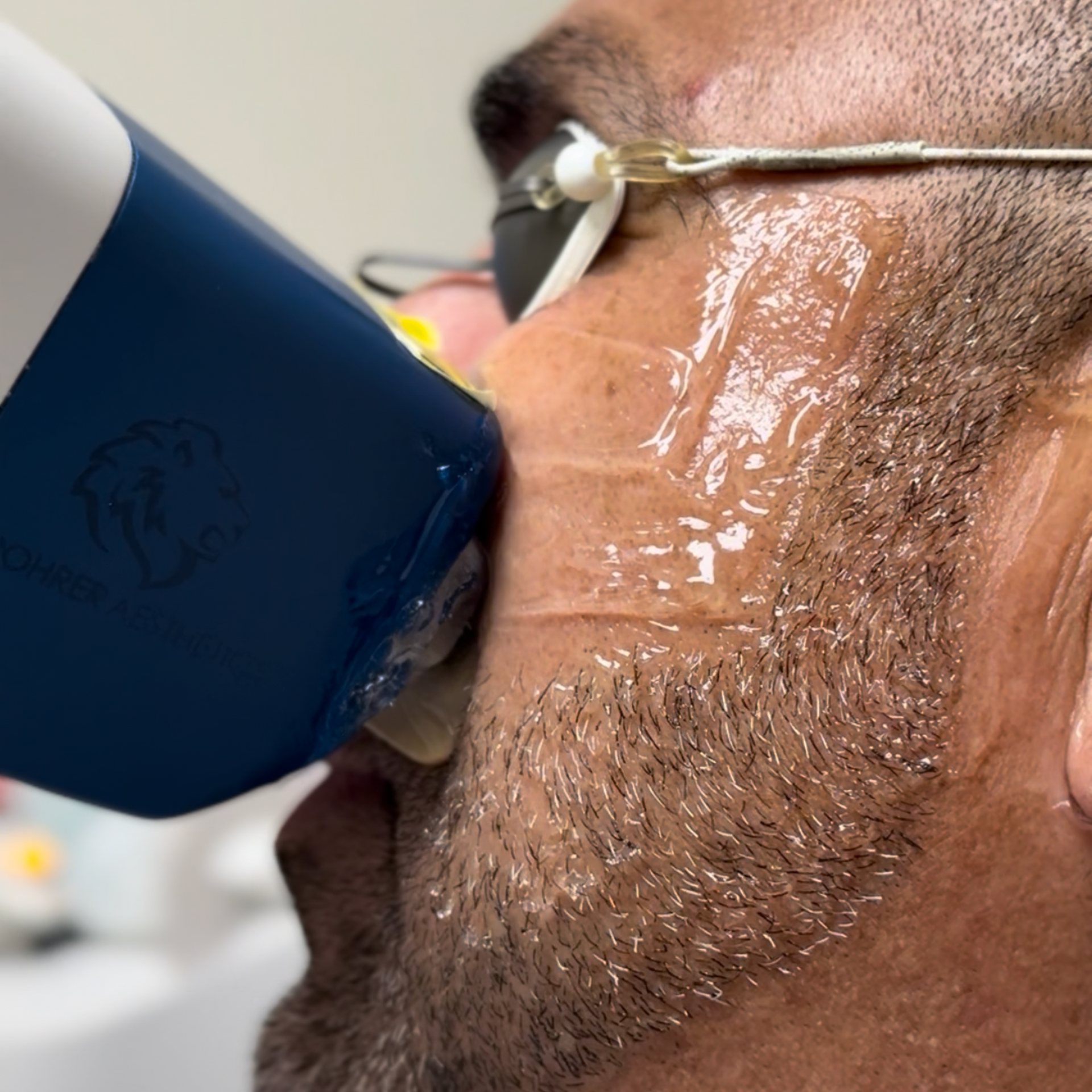 laser hair removal beard line treatment for ingrown hairs