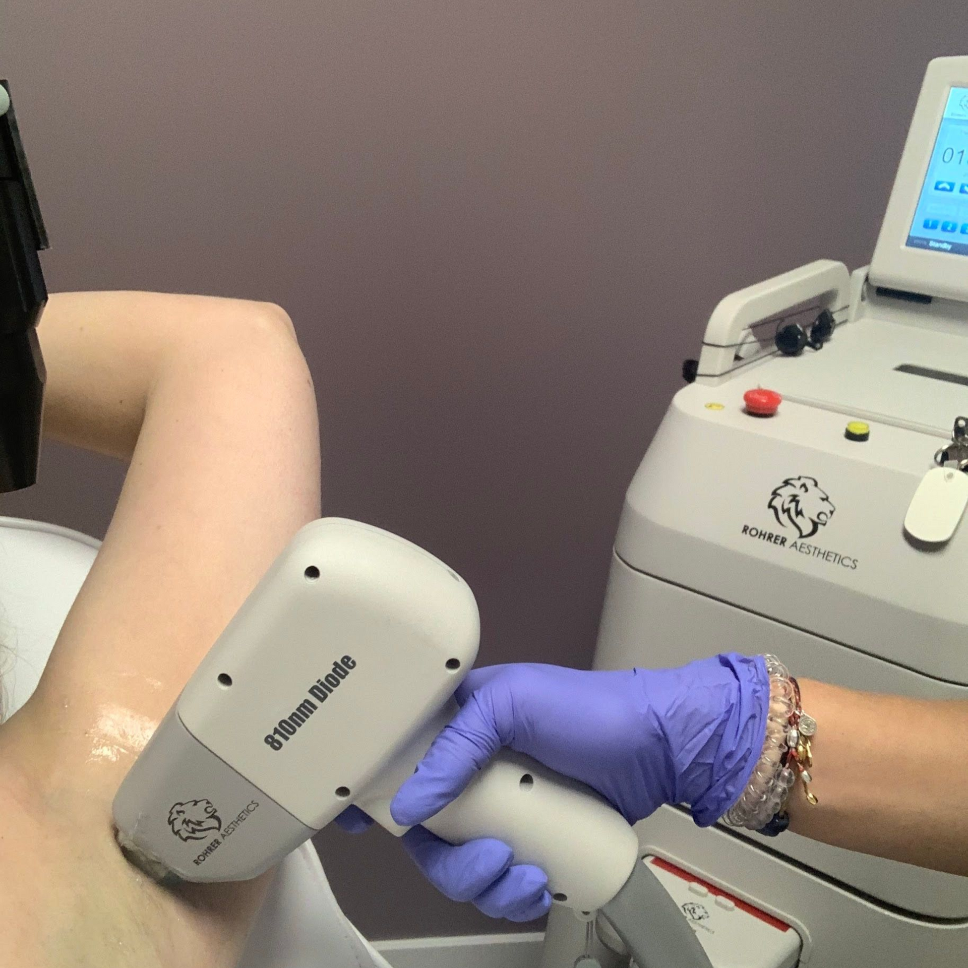 Laser Hair Removal Underarm West Point