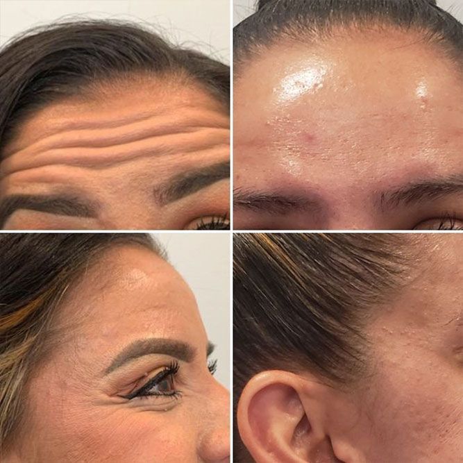 Comparison of forehead wrinkles before and after treatment, showing smoother skin.