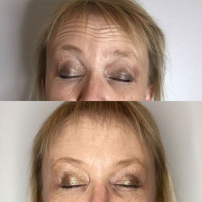 Comparison of a woman's forehead wrinkles before and after treatment, eyes closed.