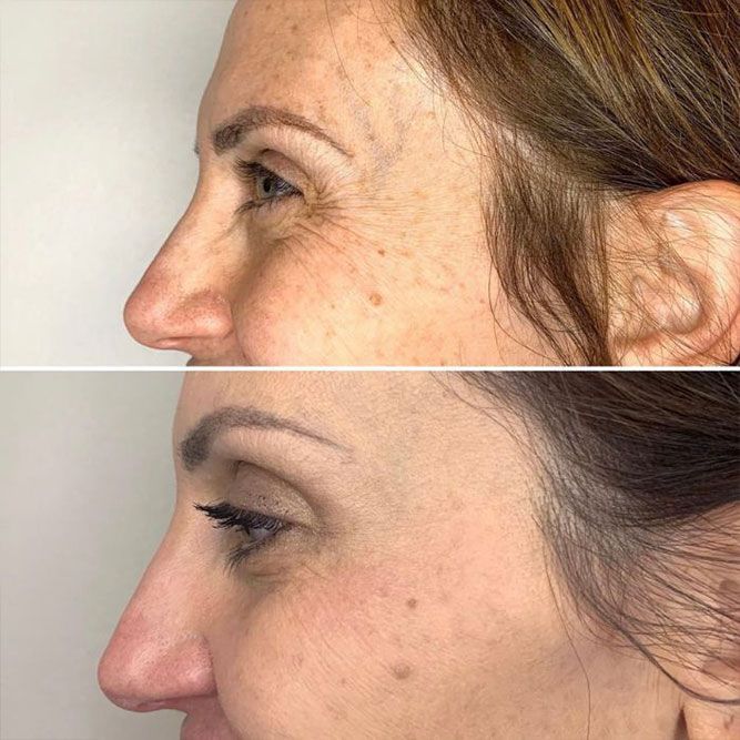 Side-by-side comparison of a person's face. Top: wrinkled skin. Bottom: smoother skin near the eyes.