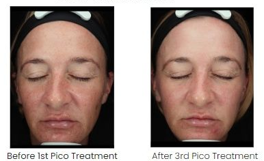 Pico melasma management before and after