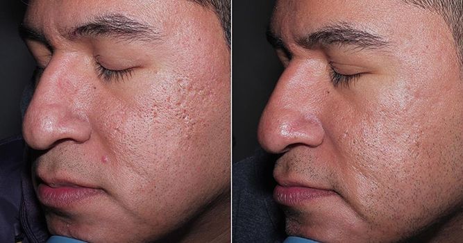 Before-and-after facial comparison. Left: scarred skin. Right: improved skin texture. Side profile, indoor setting.