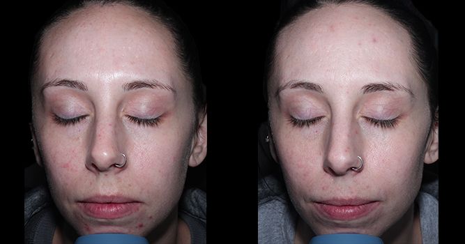 Two frontal facial views, likely before and after skincare, showing skin improvement.