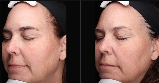 Before and after photos of a person's face; skin appears smoother after a procedure.