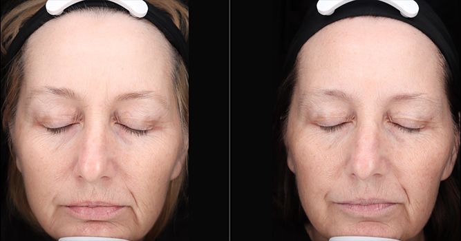 Side-by-side facial comparison showing reduction in wrinkles after treatment; woman with headband, eyes closed.