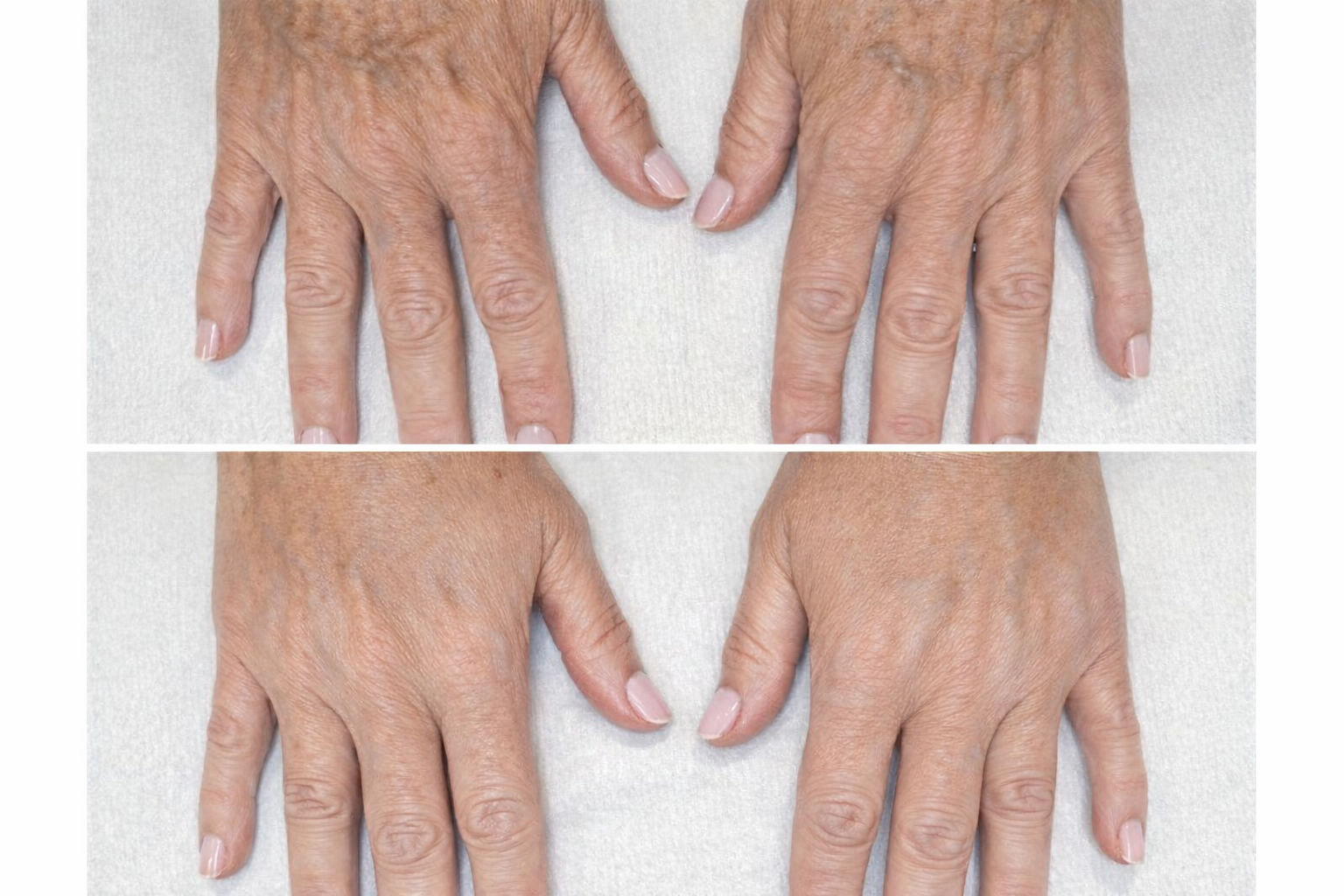 Before and after Radiesse treatment for hand rejuvenation