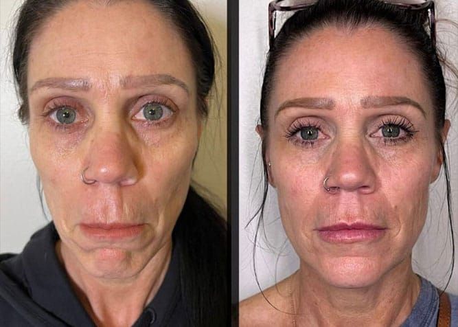 Side-by-side comparison of a person's face. Left side: droopy. Right side: smoother, lifted appearance.