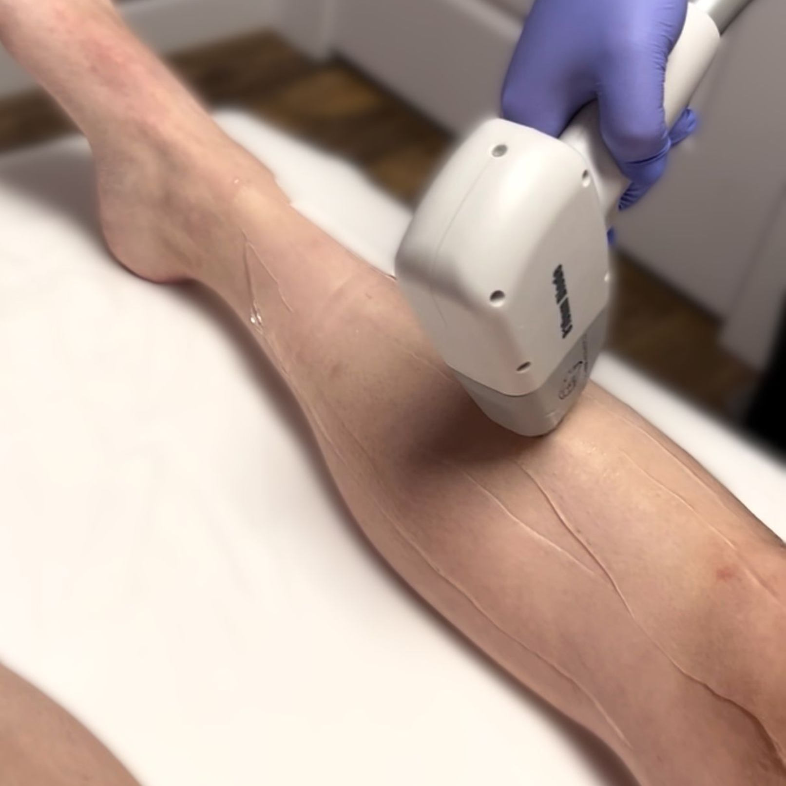 laser hair removal legs