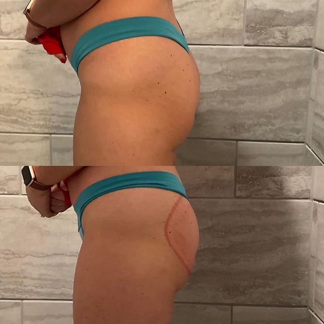 Two side-by-side photos of a person's buttocks. The top photo shows the unenhanced form. The bottom has a red outline.