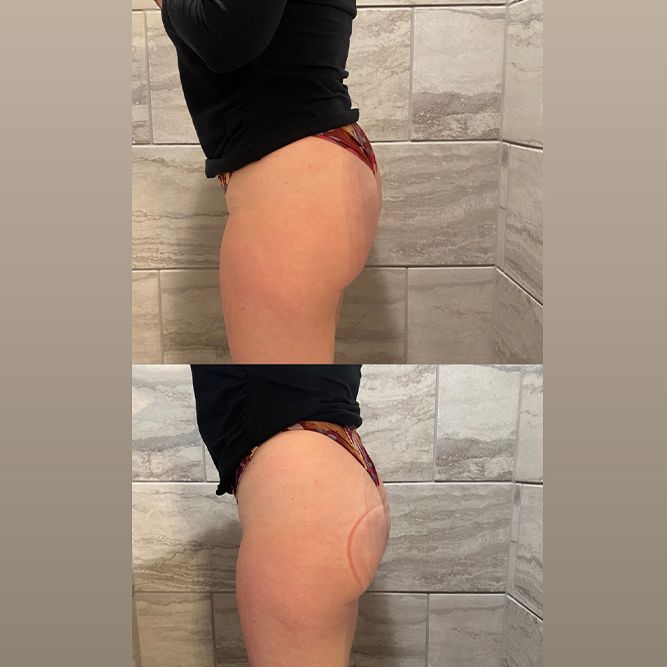 Two side-by-side photos of a person's butt, likely showing a before-and-after of a cosmetic procedure.