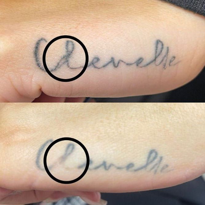 Comparison of a tattoo on a person's skin before and after laser removal, with the letter 