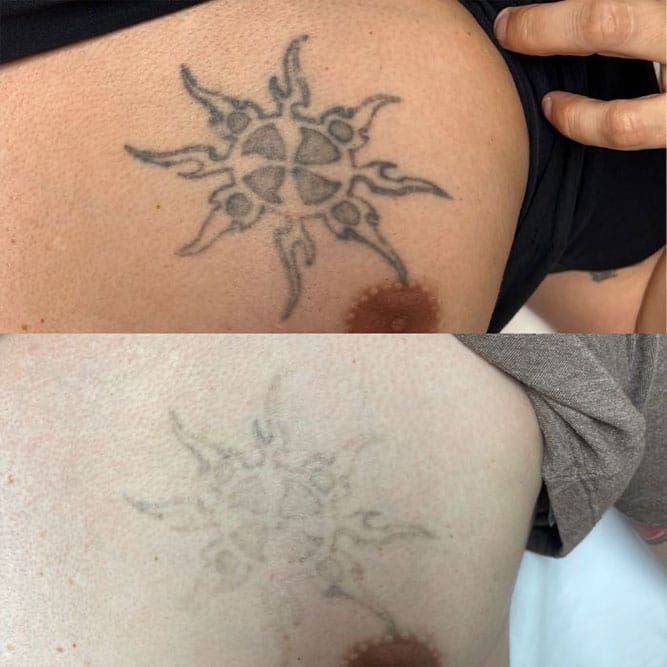 Tattoo on skin before and after removal treatment, with a sun-like tribal design, showing fading.