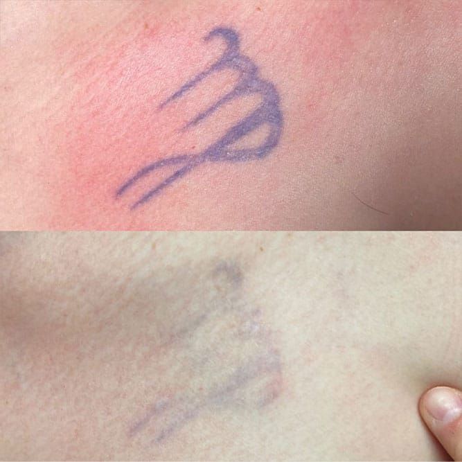 Two images of a tattoo. Top: a purple Virgo symbol on red skin. Bottom: faded version of the same symbol.