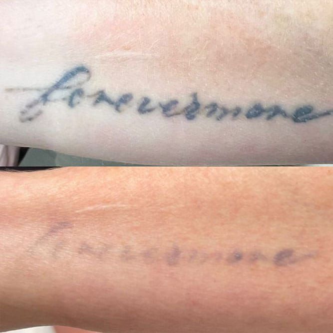 Two photos showing tattoo removal: before and after. 