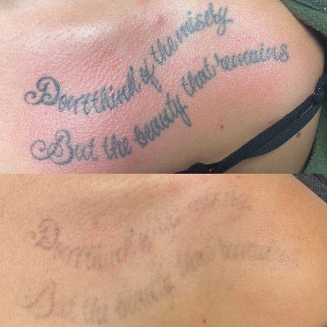 Top image: Tattoo with cursive text on skin. Bottom image: Faded version of the same tattoo after removal treatment.