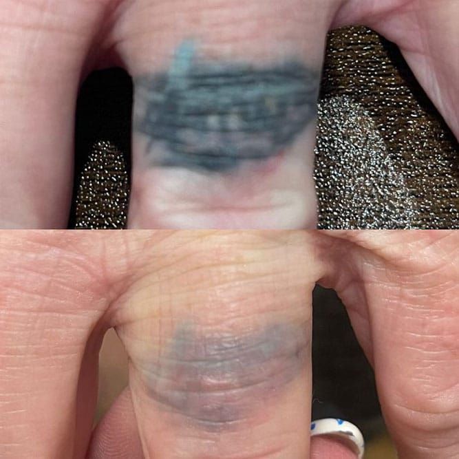 Comparison of a finger with a faded, blue-black tattoo before and after laser removal.