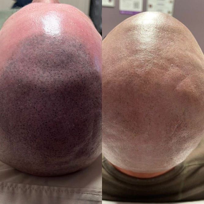 Comparison: bald head before (dark) and after (light) scalp micropigmentation treatment.