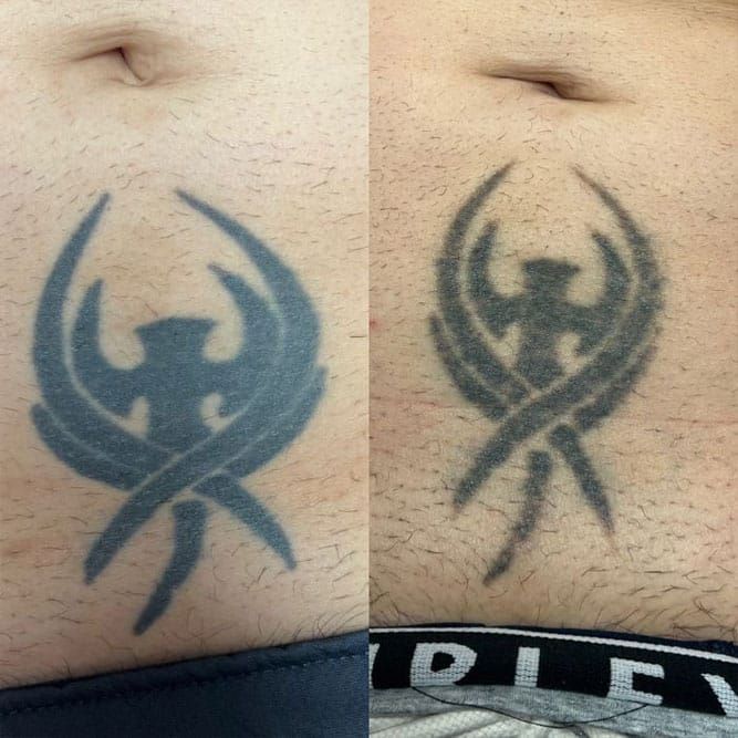 Two photos of a tattoo on a person's abdomen, before and after laser removal, showing fading of the design.