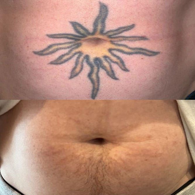 Top: Tattoo of a sun with rays. Bottom: Abdomen with no tattoo.