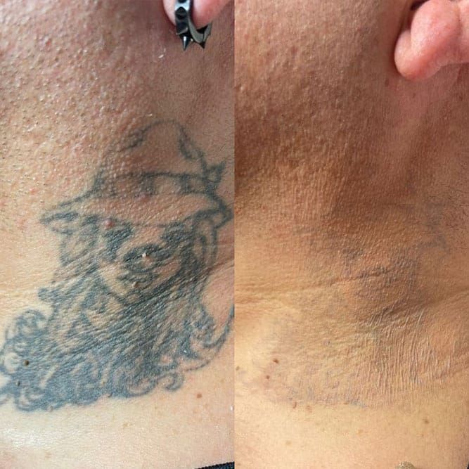 Before and after photos of tattoo removal on neck. Left: Tattoo. Right: Faded skin.