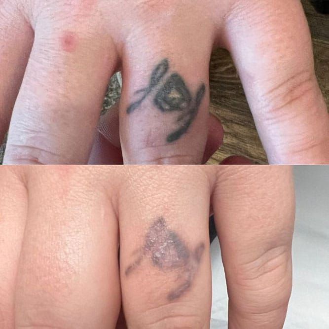 Finger with a tattoo before and after a removal treatment. The tattoo design is fading.