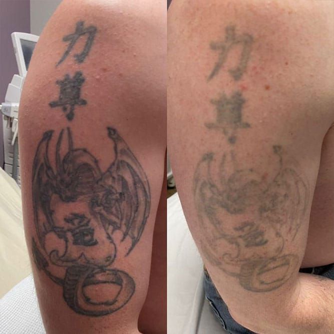 Before and after photo of a tattoo on an arm, showing significant fading after tattoo removal treatment.