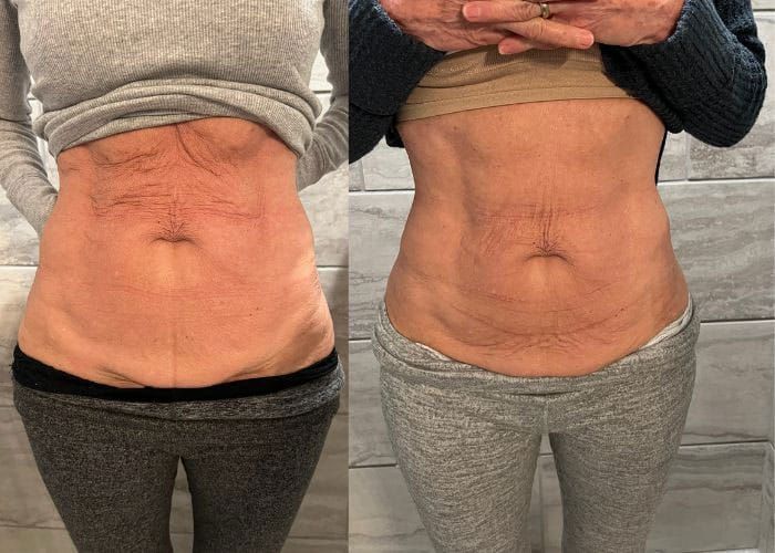 Before and after comparison of a person's abdomen, showing skin tightening effects.