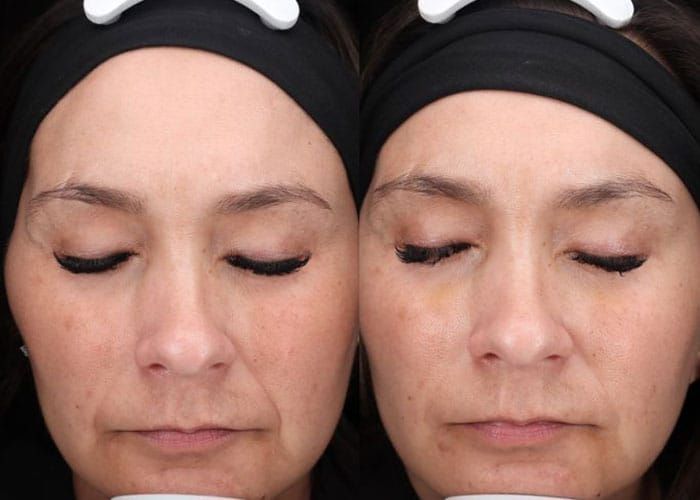 Before and after comparison of a woman's face, showing a reduction in wrinkles and improved skin appearance.