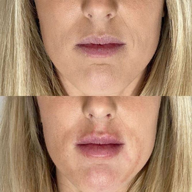 Before and after close-up of a woman's lips, showing reduction of lip wrinkles and increased fullness after treatment.