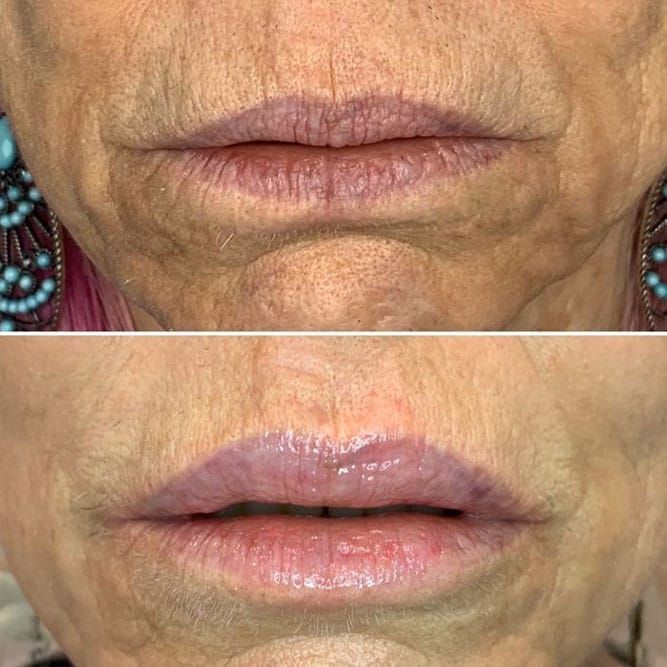 Comparison of a person's lips. Top: thinner, wrinkled lips. Bottom: fuller, plump lips with glossy appearance.