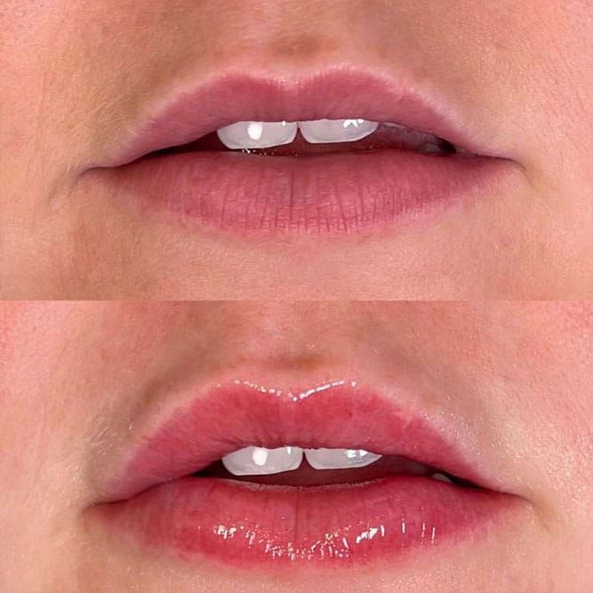 Comparison of lips before and after lip filler treatment; top lips are smaller, bottom lips are fuller.