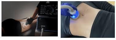 Cryotherapy T-Shock: The Ultimate Treatment for Fat Reduction, Cellulite,  and Anti-Aging