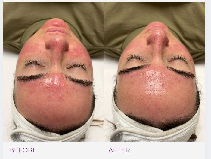 Laser carbon peel before and after.